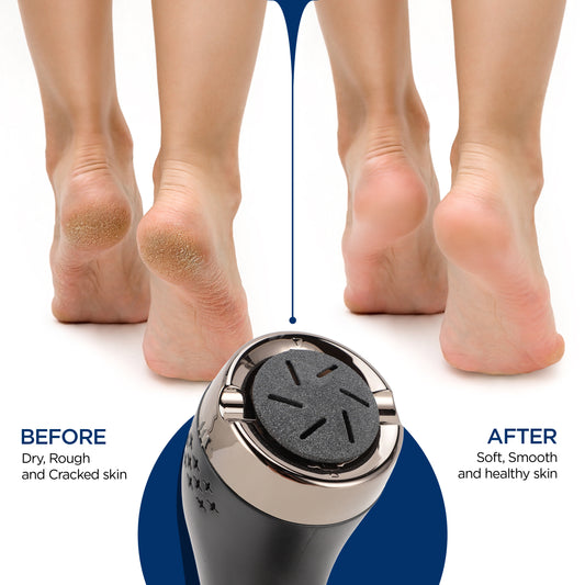 Feetish Callus Remover